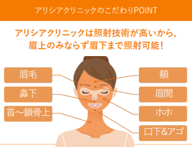 アリシア_顔の脱毛範囲.png