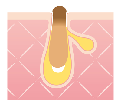 角栓