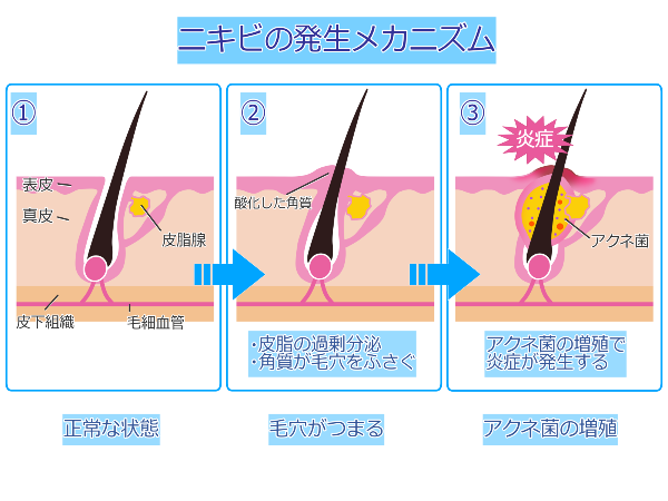 ニキビ_イラスト