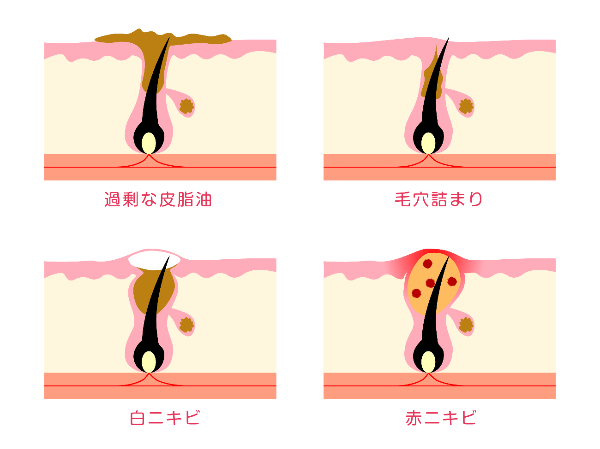 ニキビ各種_イラスト