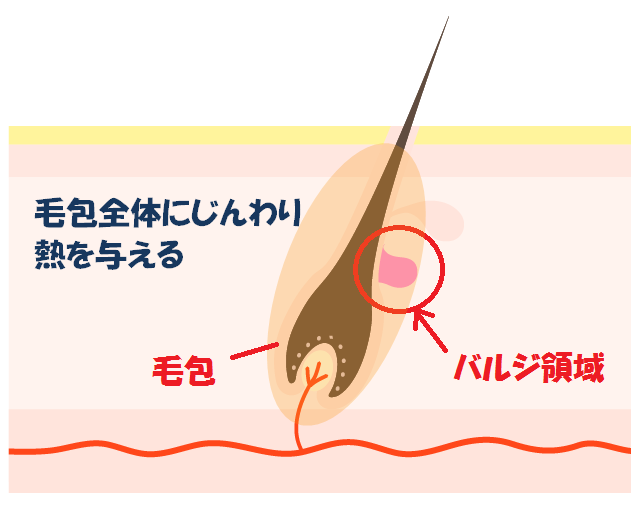 バルジ_イラスト1