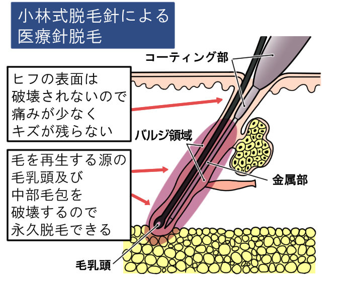 ビューティs_小林式絶縁イラスト