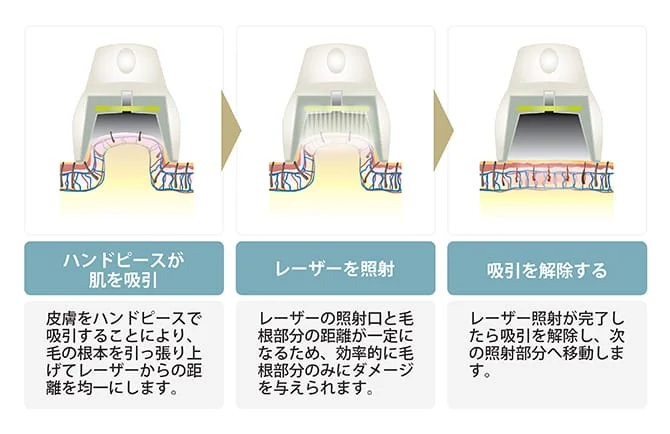 ライトシェア吸引_イラスト