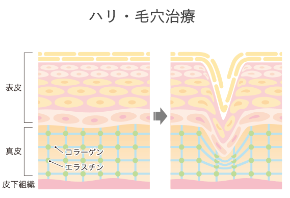 レジーナ_ピコフラクショナル