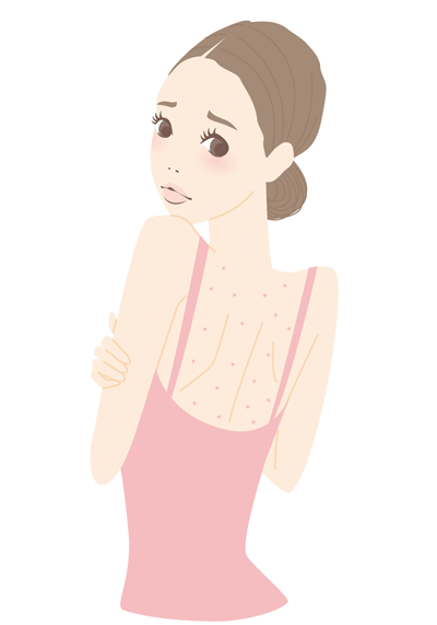背中ニキビ_イラスト