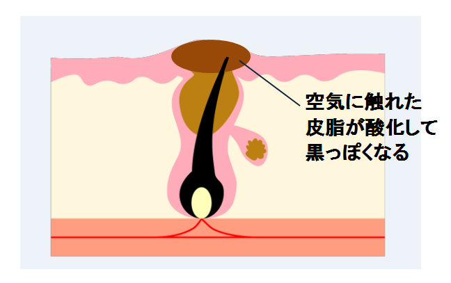 黒ニキビ_酸化イラスト